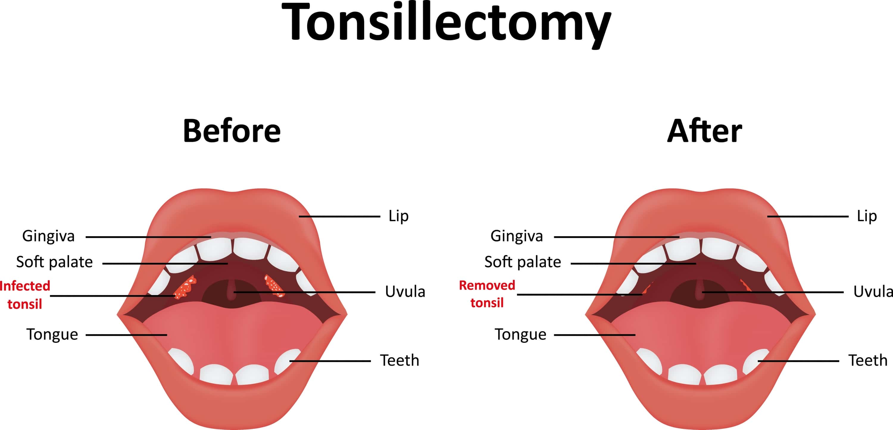 possible complications of tonsillectomy