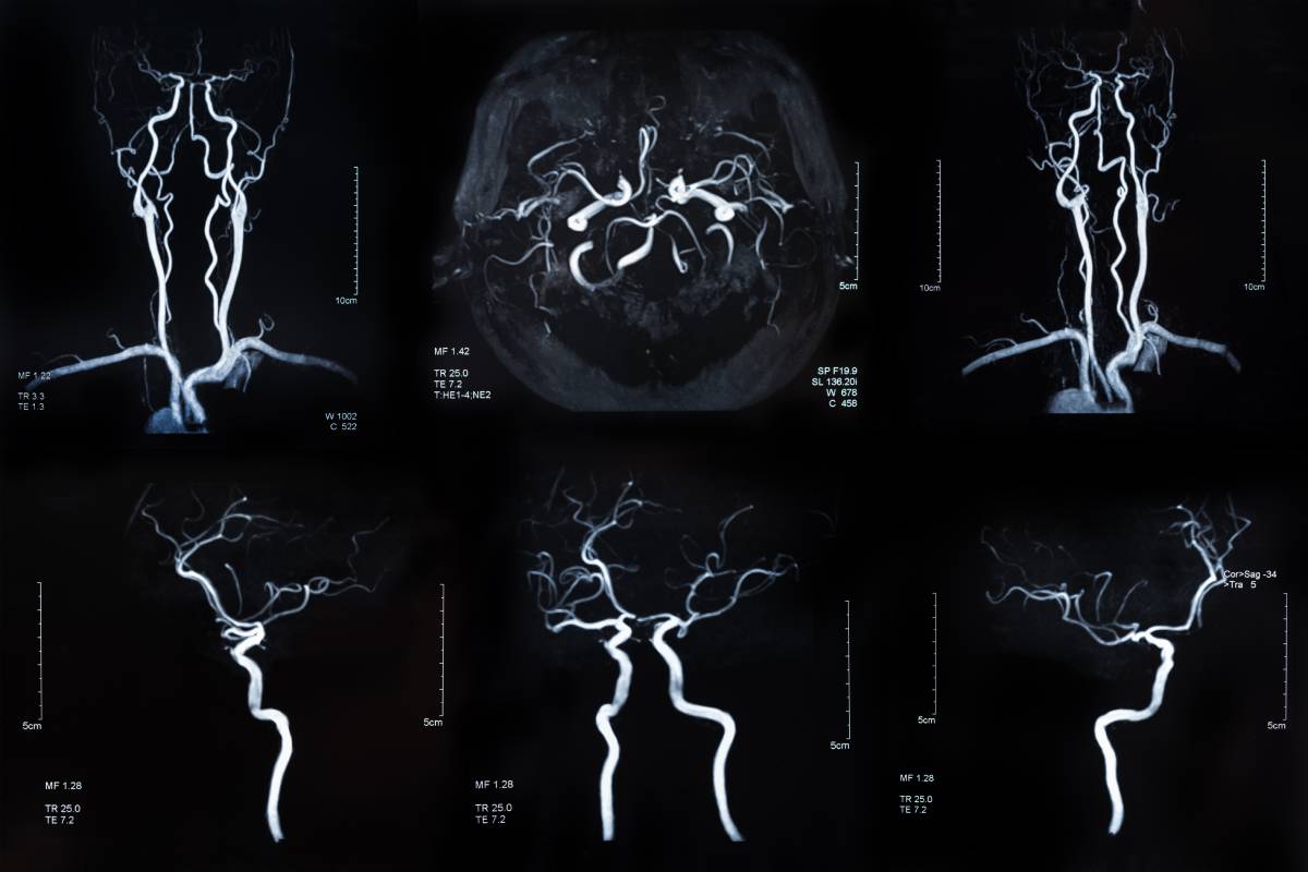 Anesthesia Management of Endovascular Therapy 